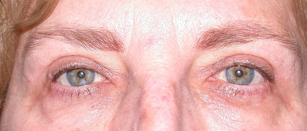 Ptosis Repair Edison
