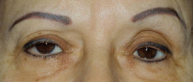 Ptosis Repair Edison