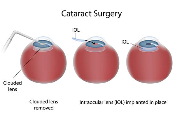 Cataract Surgery Edison Cataract Surgery Edison